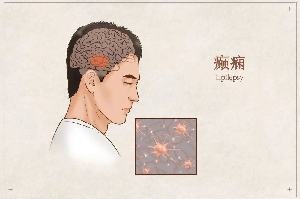 老人癫痫