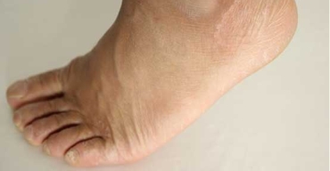 为什么老年人会出现脚肿现象？