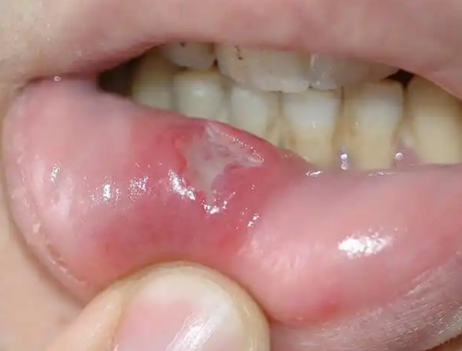 冠心病能引起口腔溃疡吗